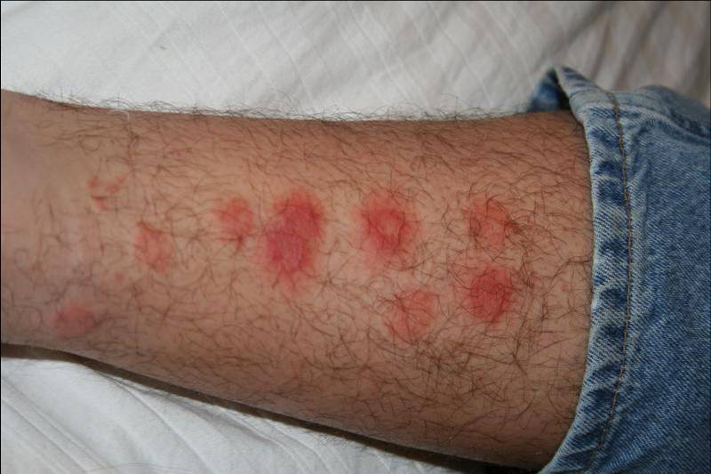 photos of bug bites that itch